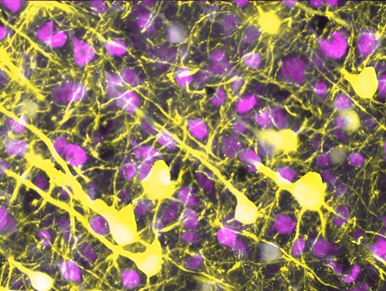 Comment le cerveau enflammé se déconnecte après un accident vasculaire cérébral