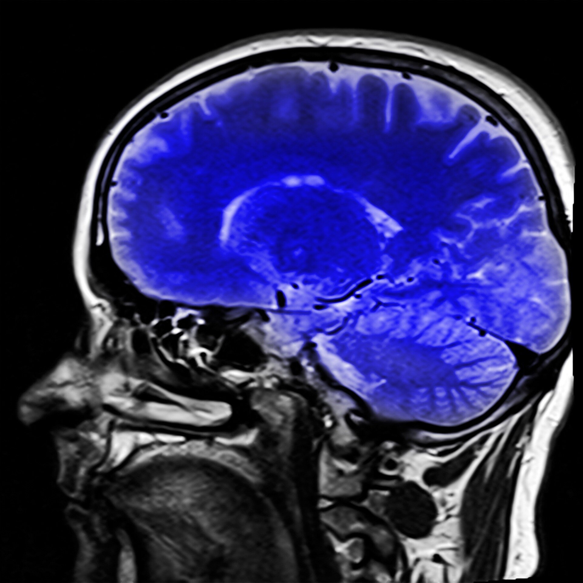 Une étude d'imagerie cérébrale révèle des connexions essentielles à la conscience humaine
