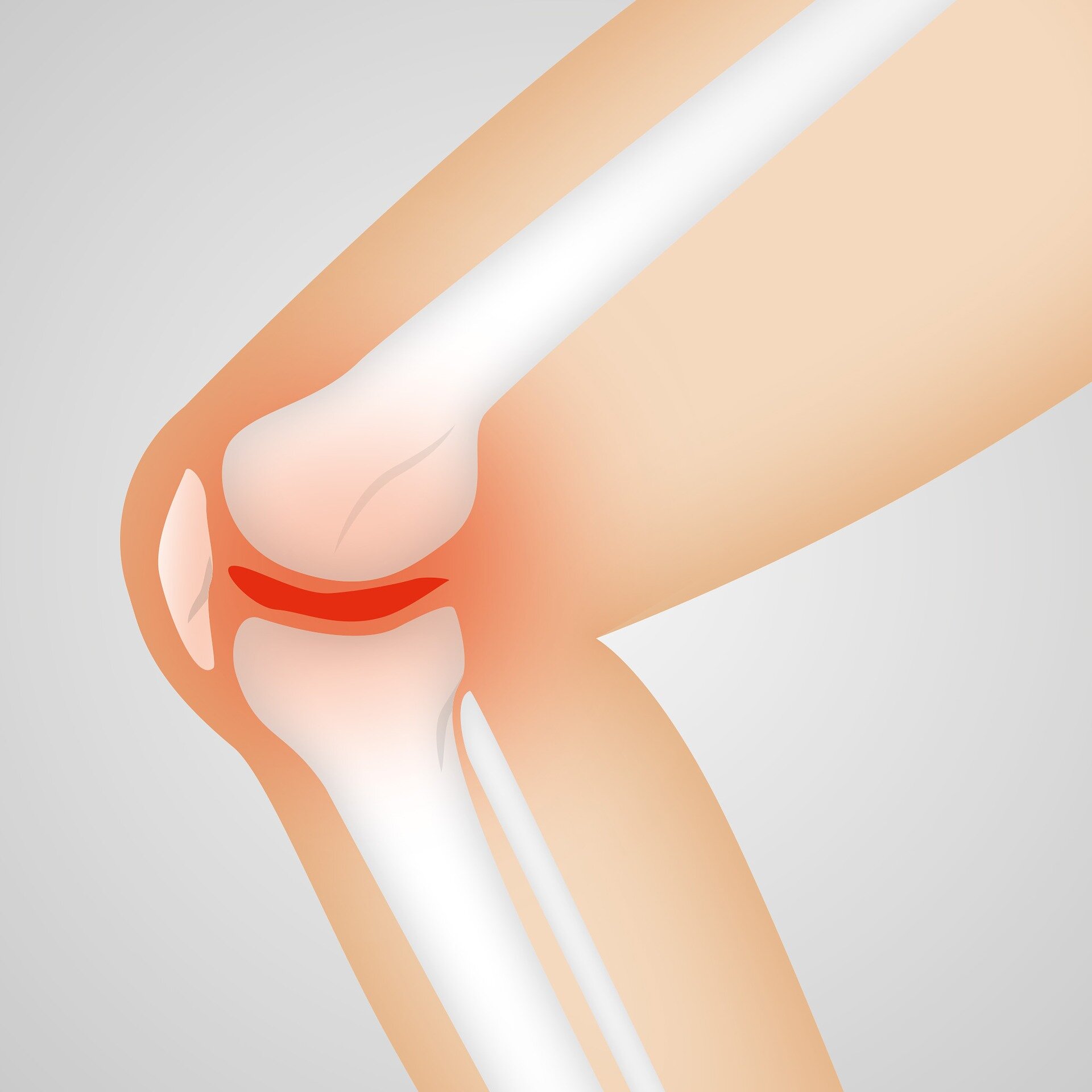Une nouvelle technique aide à prédire le risque de déchirure du ménisque du genou