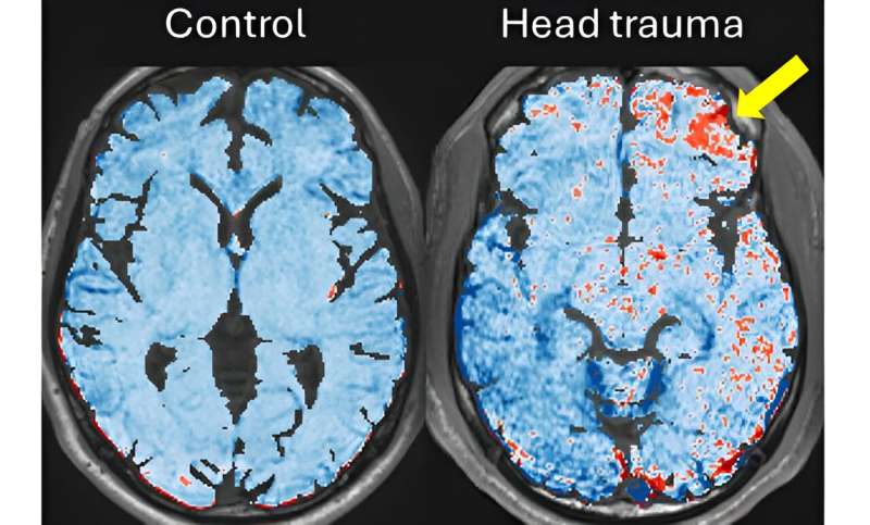Les scientifiques découvrent que de petits coups répétés sur la tête des joueurs de football peuvent endommager les vaisseaux sanguins du cerveau