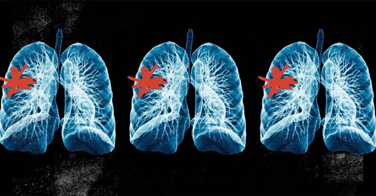 Comment le diagnostic et le traitement précoces de l’asthme et de la BPCO peuvent grandement…
