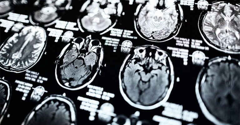 Comment l'IRM peut aider au diagnostic et au traitement de la maladie de Parkinson
