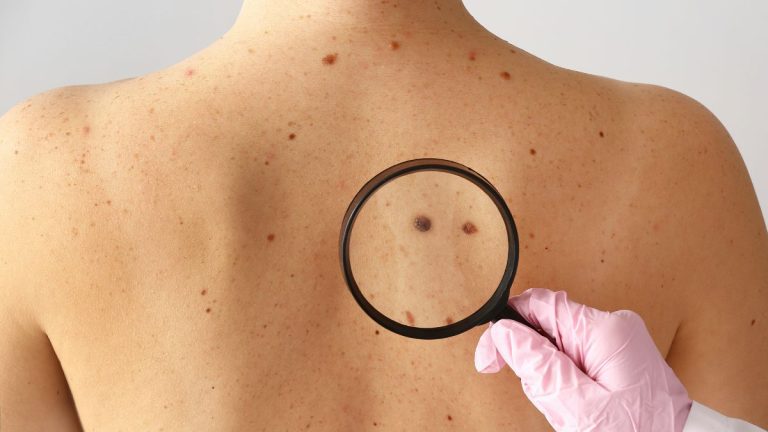 loupe medecin sur melanome