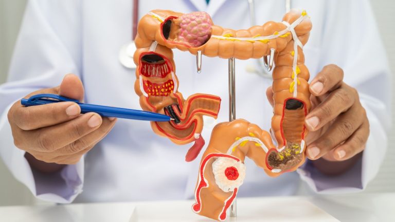 un medecin montre un colon