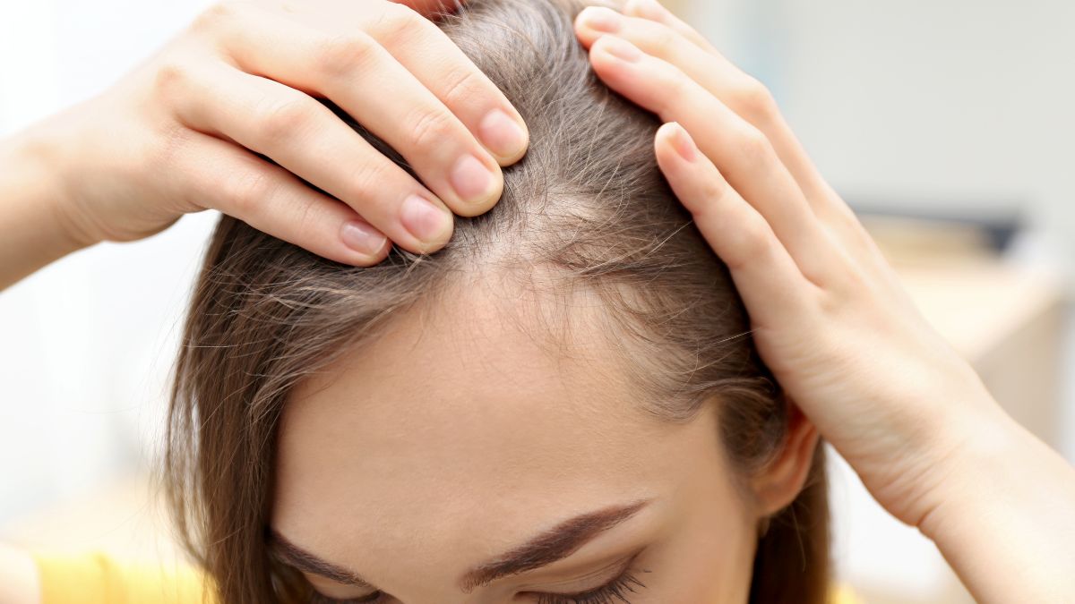 femme montrant ses pertes de cheveux