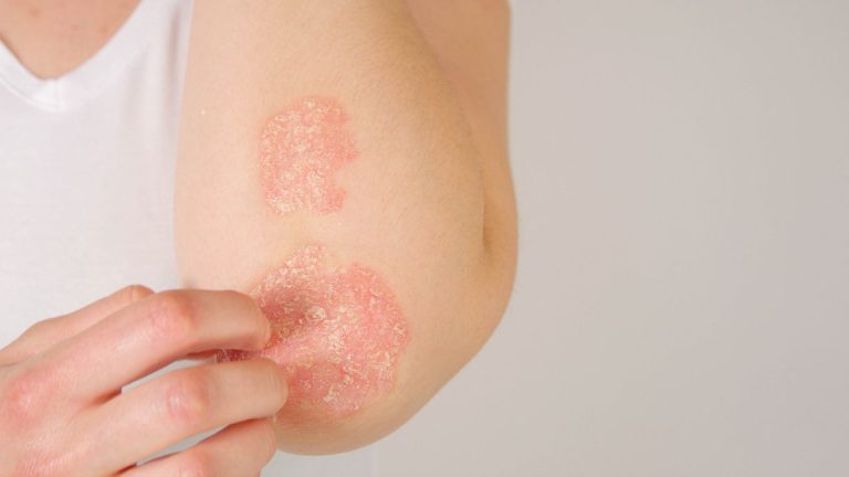 des plaques de psoriasis sur coude