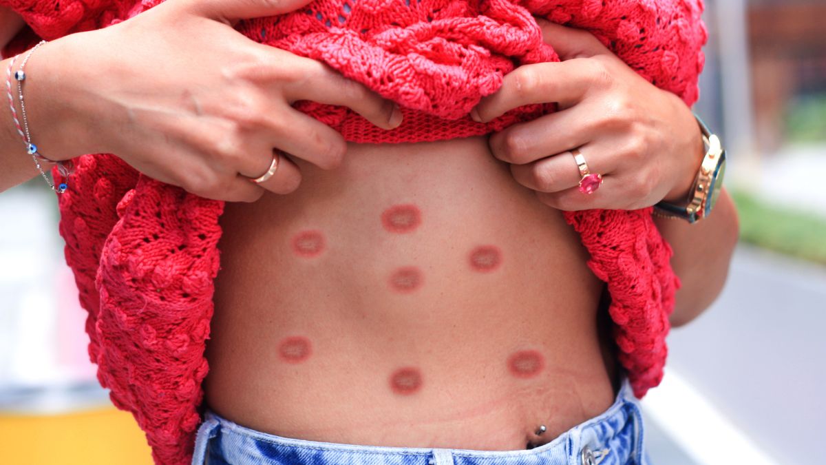 boutons de variole du singe sur ventre